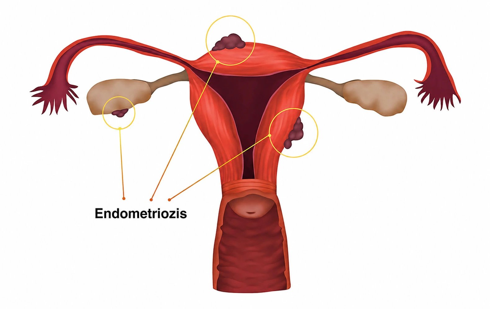 endometriozis nedir endometriozis belirtileri