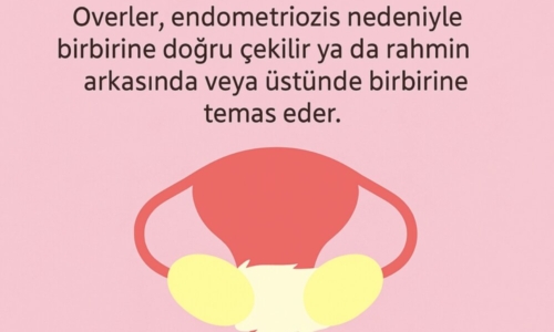Öpüşen yumurtalıklar (kissing over) nedir?