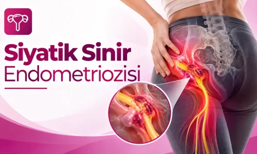 siyatik sinir endometriozis belirtileri