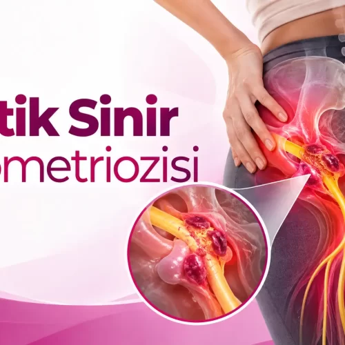 siyatik sinir endometriozis belirtileri